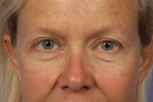 Eyelid Surgery Before & After Image