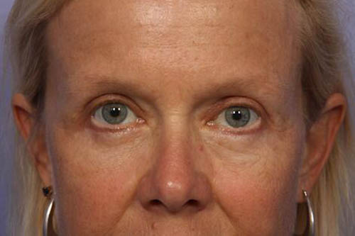 Eyelid Surgery Before & After Image