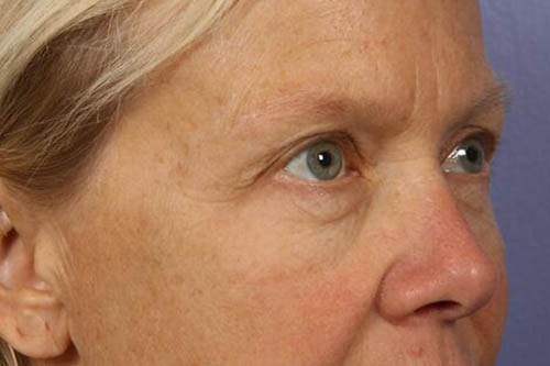 Eyelid Surgery Before & After Image