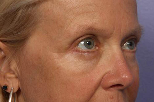 Eyelid Surgery Before & After Image