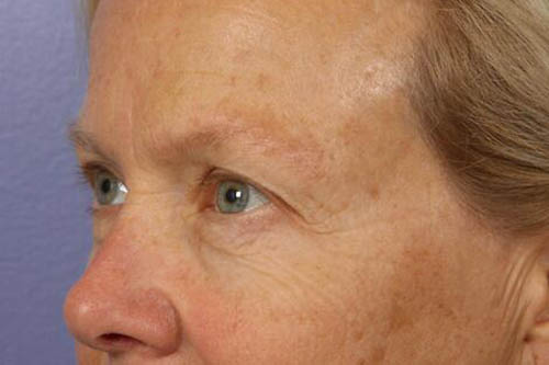 Eyelid Surgery Before & After Image