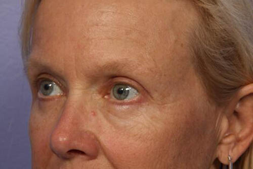 Eyelid Surgery Before & After Image