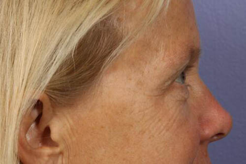 Eyelid Surgery Before & After Image