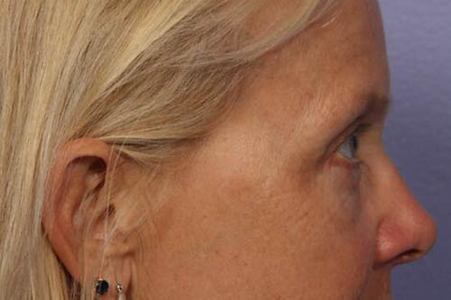 Eyelid Surgery Before & After Image