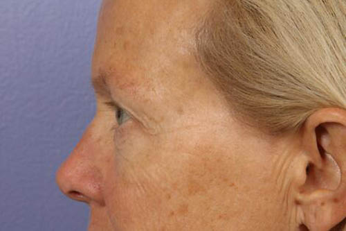 Eyelid Surgery Before & After Image