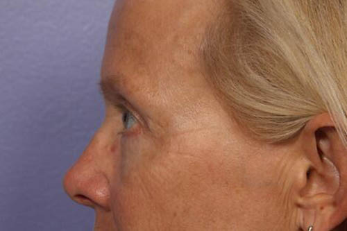 Eyelid Surgery Before & After Image