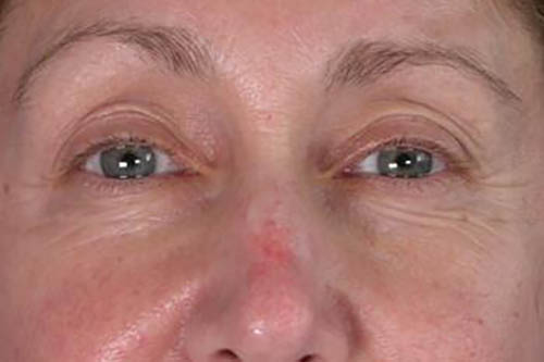 Eyelid Surgery Before & After Image