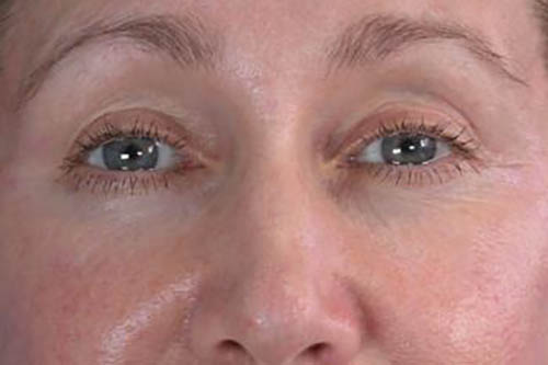 Eyelid Surgery Before & After Image