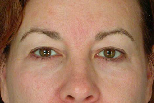 Eyelid Surgery Before & After Image