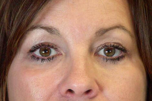 Eyelid Surgery Before & After Image