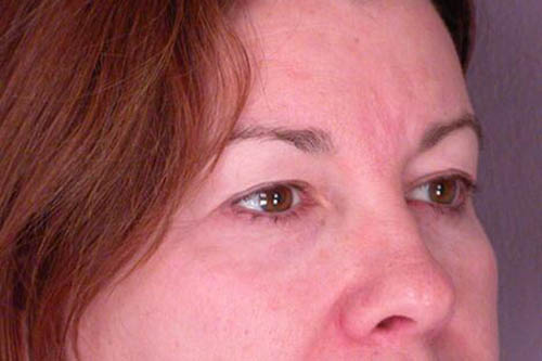 Eyelid Surgery Before & After Image