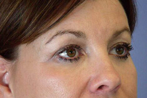 Eyelid Surgery Before & After Image