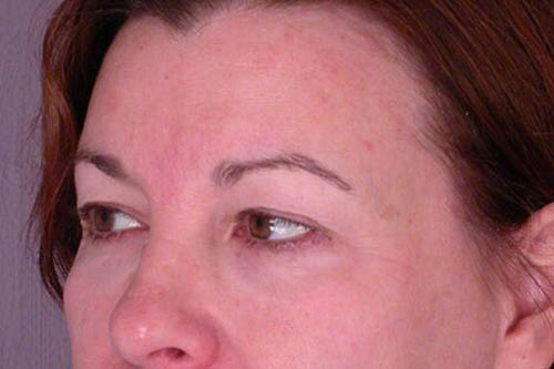 Eyelid Surgery Before & After Image