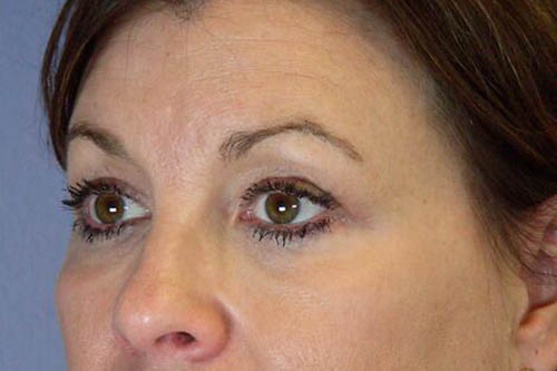 Eyelid Surgery Before & After Image