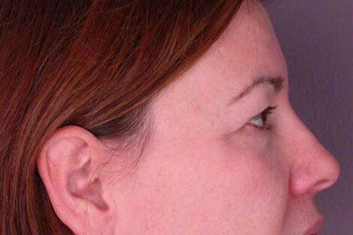 Eyelid Surgery Before & After Image