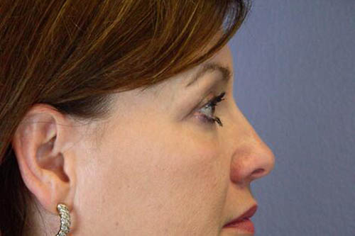 Eyelid Surgery Before & After Image