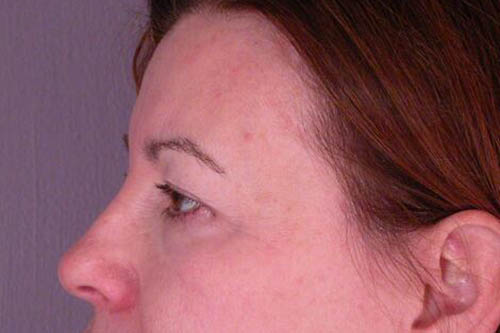 Eyelid Surgery Before & After Image