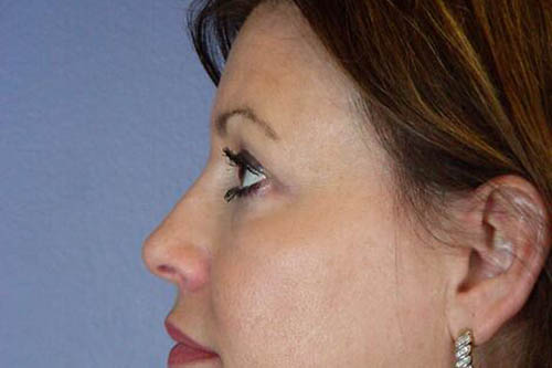 Eyelid Surgery Before & After Image