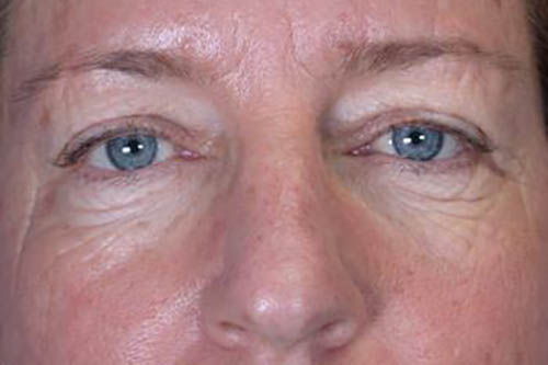 Eyelid Surgery Before & After Image