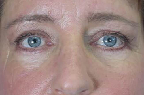 Eyelid Surgery Before & After Image