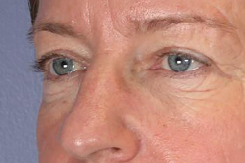 Eyelid Surgery Before & After Image