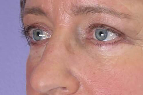 Eyelid Surgery Before & After Image