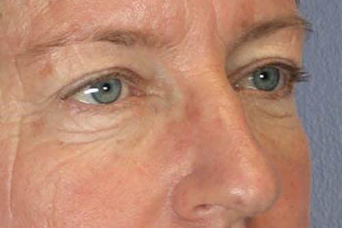 Eyelid Surgery Before & After Image