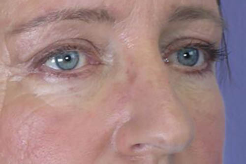 Eyelid Surgery Before & After Image