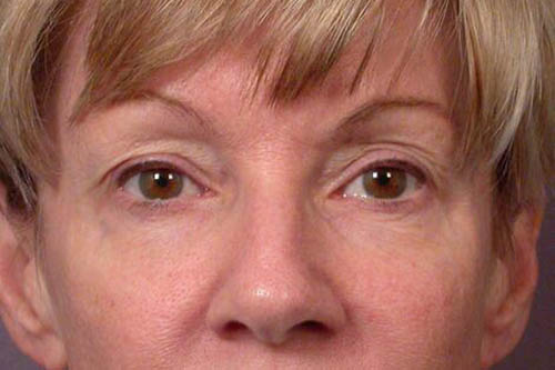 Eyelid Surgery Before & After Image