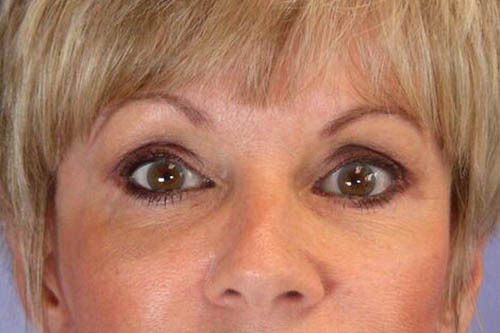 Eyelid Surgery Before & After Image