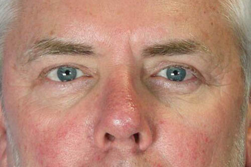 Eyelid Surgery Before & After Image