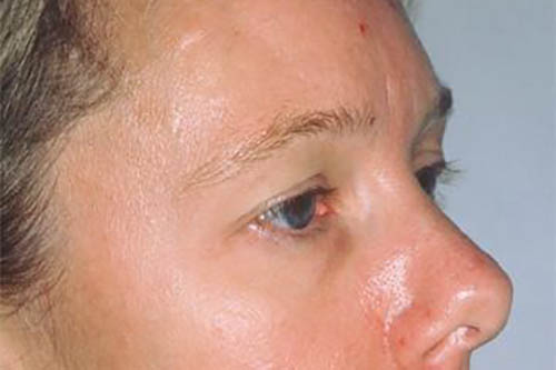 Eyelid Surgery Before & After Image