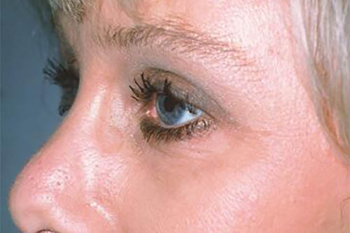 Eyelid Surgery Before & After Image