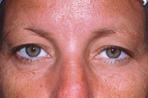 Eyelid Surgery Before & After Image