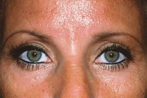 Eyelid Surgery Before & After Image