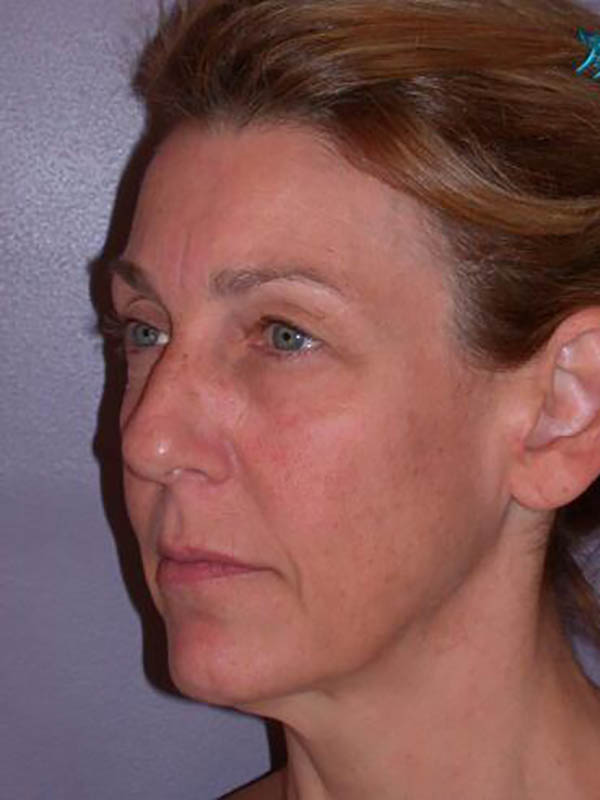 Eyelid Surgery Before & After Image