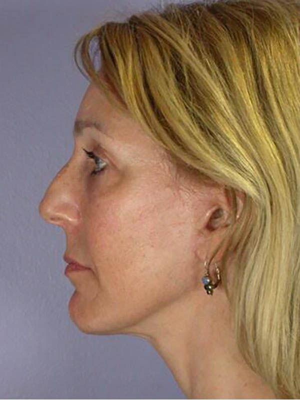 Eyelid Surgery Before & After Image