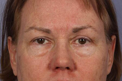 Eyelid Surgery Before & After Image