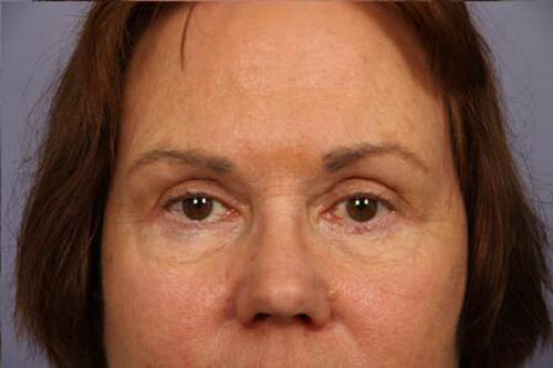 Eyelid Surgery Before & After Image