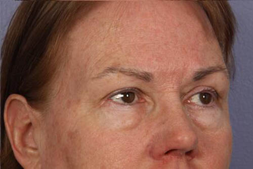 Eyelid Surgery Before & After Image