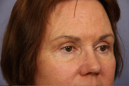 Eyelid Surgery Before & After Image