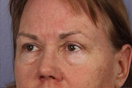 Eyelid Surgery Before & After Image