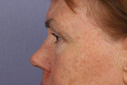 Eyelid Surgery Before & After Image