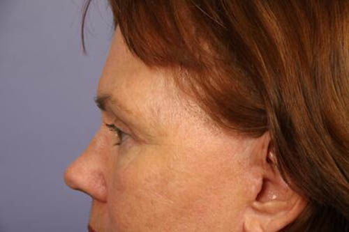 Eyelid Surgery Before & After Image