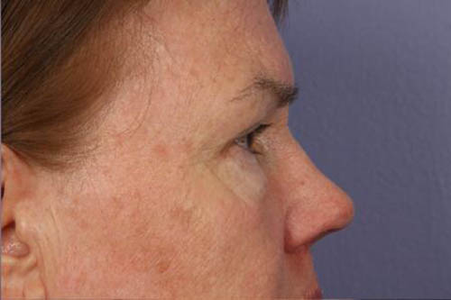 Eyelid Surgery Before & After Image