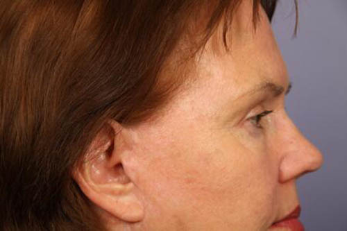 Eyelid Surgery Before & After Image