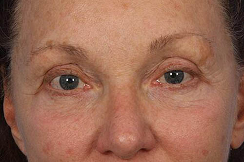 Eyelid Surgery Before & After Image