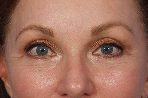 Eyelid Surgery Before & After Image