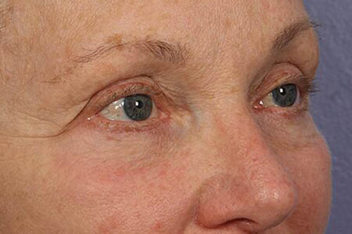 Eyelid Surgery Before & After Image