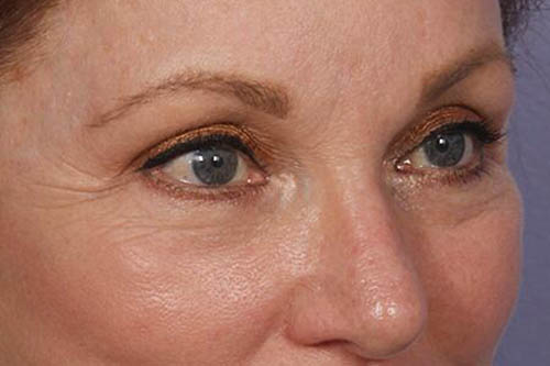 Eyelid Surgery Before & After Image